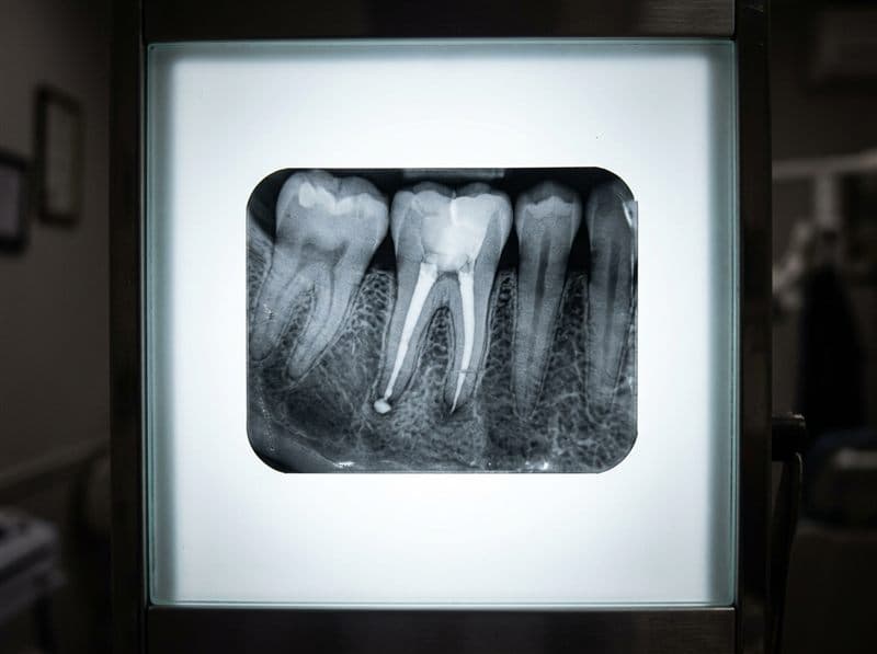 Radiografía de un diente con endodoncia oscurecido