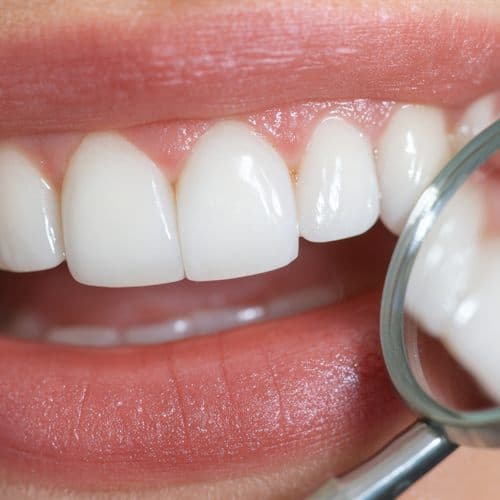 Sonrisa con dientes blancos tras un blanqueamiento dental en Chantada