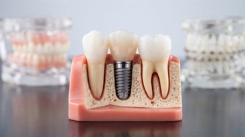 Maqueta de implante dental entre dientes naturales, tratamiento en Chantada