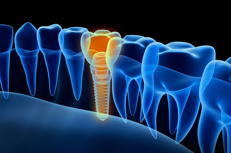 Las mejores marcas en Clínica Dental Marcos Anache