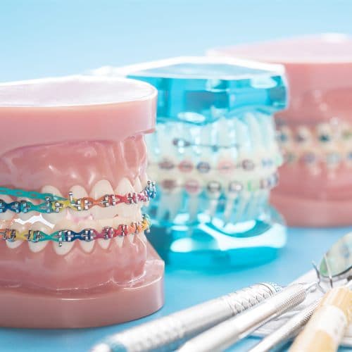 Modelos dentales con brackets de colores y alineador para ortodoncia en Chantada