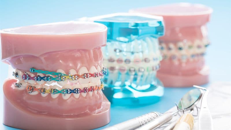 Modelos dentales con brackets de ortodoncia en la clínica de Chantada